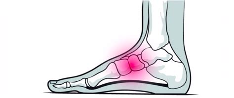 What is a Jones Fracture? All your questions answered here