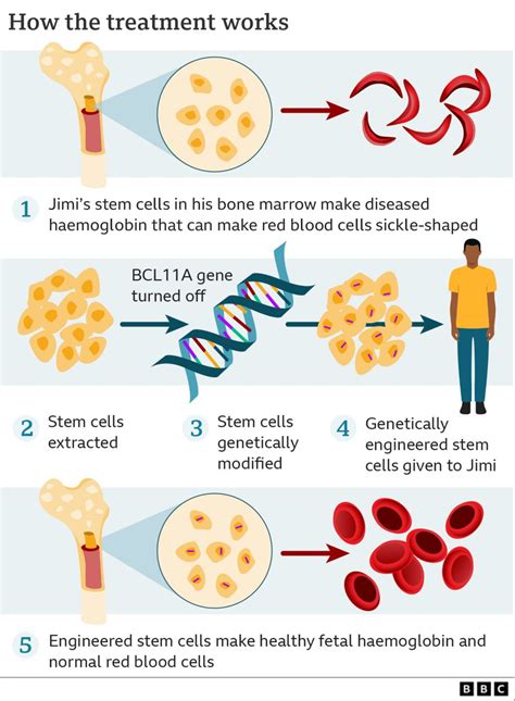 Sickle cell: ‘The revolutionary gene-editing treatment that gave me new life’ - BBC News