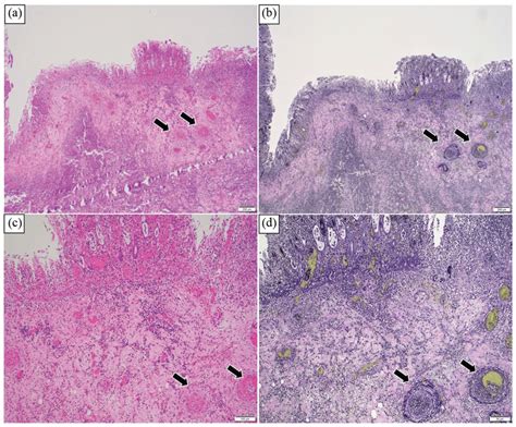 (a, c) Mucosal ulcer with vasculitis (black arrows, 4× and 10× ...