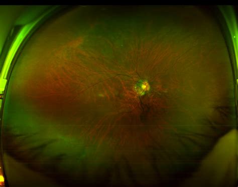 My PVD, Weiss Ring Floater & FOV Surgeries (12/7/15 & 7/17/17) - Degenerative Vitreous