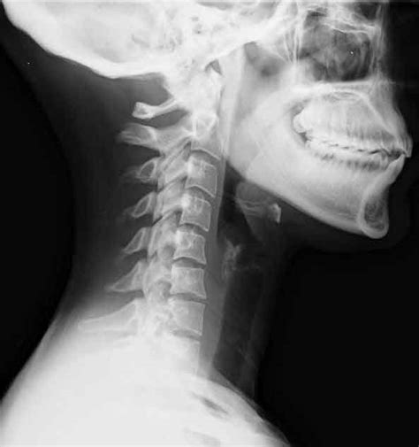 BROKEN NECK | Buyxraysonline