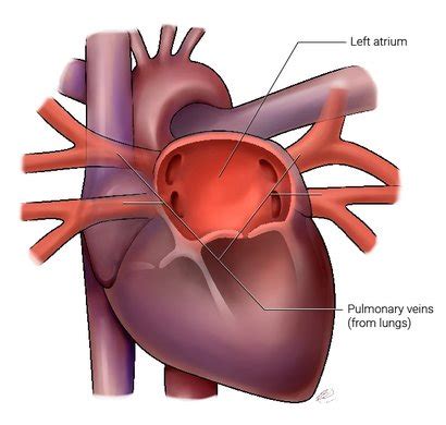 AF and the pulmonary veins