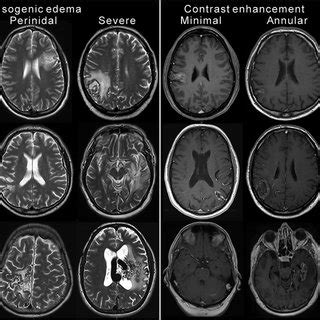 Example images from different patients demonstrating radiation-induced ...