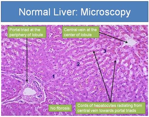 Morphology of Alcoholic Liver Disease – Medchrome