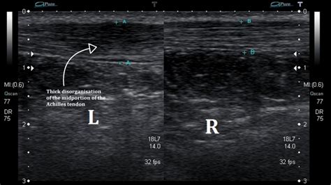 Ultrasound Images of Achilles Tendinopathy - Ankle, Foot and Orthotic ...