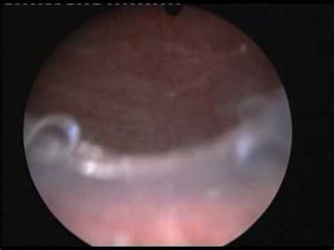 Prostatic Stent 1procedure SIU 2009 office urology instructional course ...