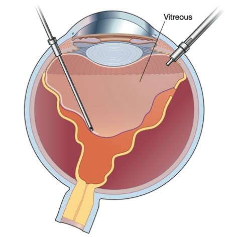 What is Vitrectomy | Retina Specialist | Orange County 92660