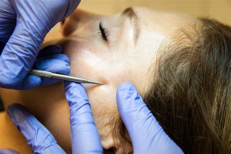 Milia Extraction in Rochester, New York | Envision Eye & Aesthetics