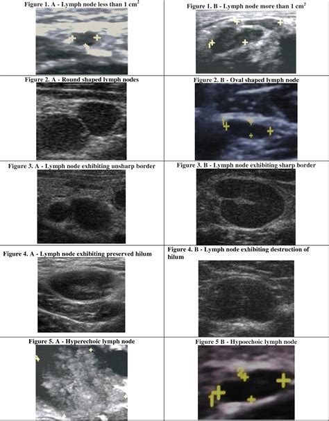 Figure 1 from CLINICAL EVALUATION AND ULTRASONOGRAPHIC CHARACTERIZATION OF CERVICOFACIAL LYMPH ...