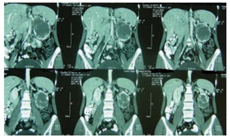 Pancreatic Cystic Tumors | Oncohema Key