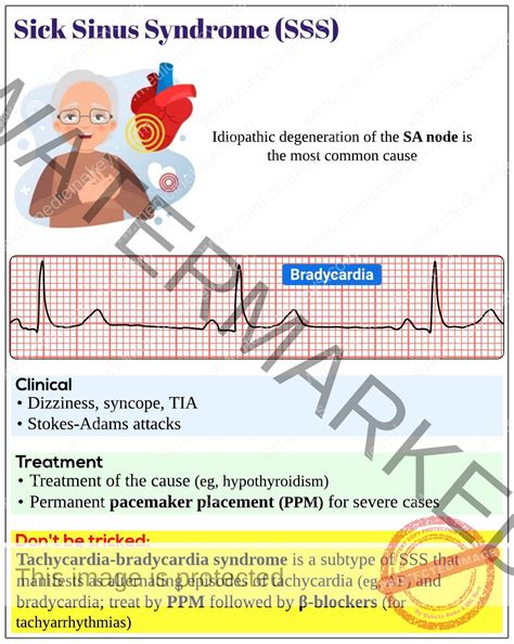 Sick sinus syndrome (sinus node dysfunction) - Medicine Keys for MRCPs