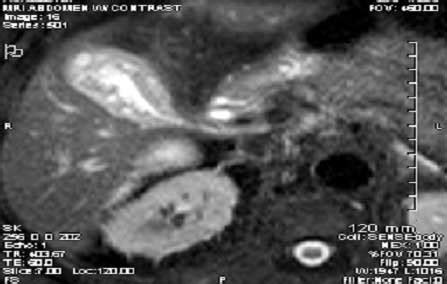 Adenomyomatosis | 123sonography