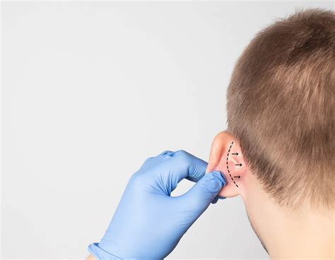 Ear Surgery in San Antonio, TX | Otoplasty | Ear Pinning