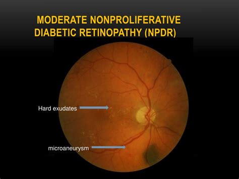 PPT - DIABETIC RETINOPATHY PowerPoint Presentation, free download - ID:788556