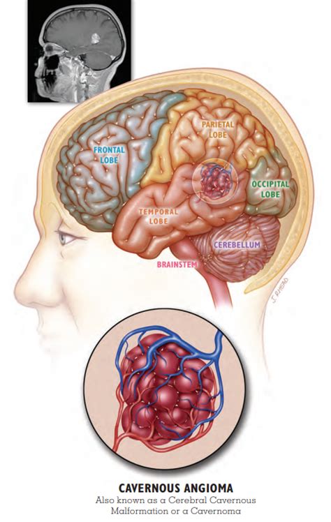 Cavernous Malformation Fast Facts - Alliance to Cure Cavernous Malformation