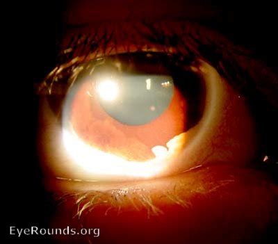 Ectropion uveae. EyeRounds.org: Online Ophthalmic Atlas