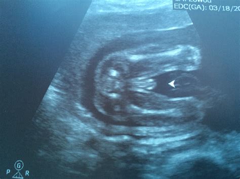 Our Terrifying 20 Week Anatomy Scan