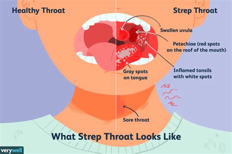 What Is Strep Throat: Overview and More