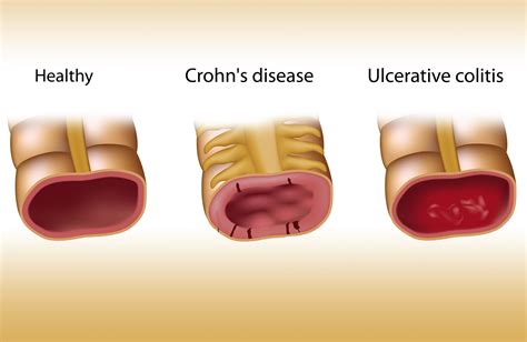 Inflammatory bowel disease and cannabis - a field report