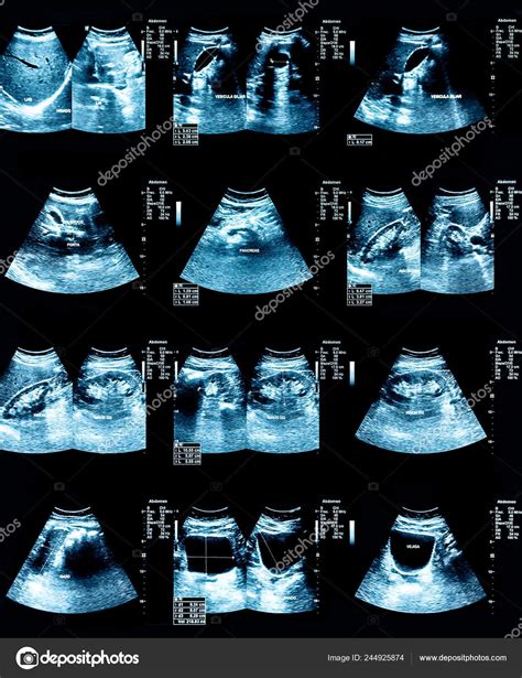 Echography Image Ultrasound Abdomen Stock Illustration by ©agcuesta1 #244925874