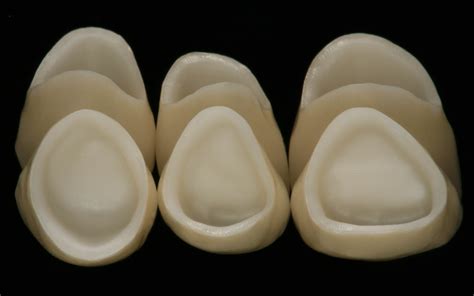 Six maxillary anterior all-ceramic crowns | FOR.org