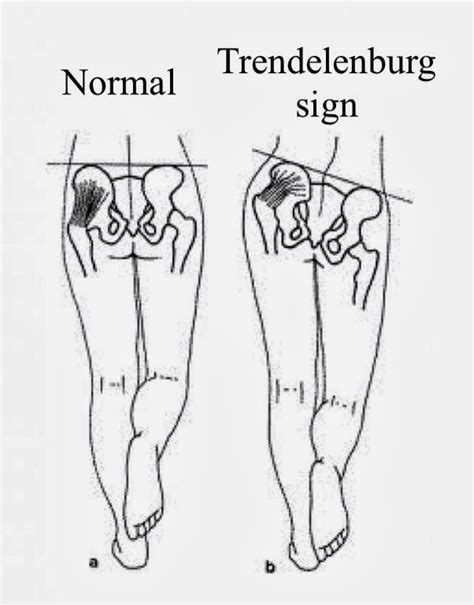 Examination of Hip : Trendelenburg test or sign | Epomedicine