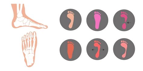 Premium Vector | Types of deformity foot