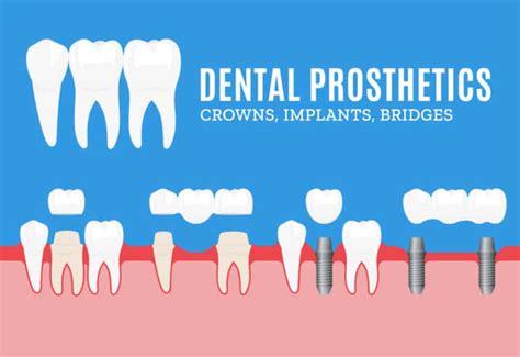 Prosthodontics in Bangalore - Best Dental clinic in Bangalore