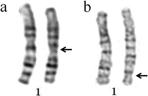 Pericentric inversion in chromosome 1 and male infertility