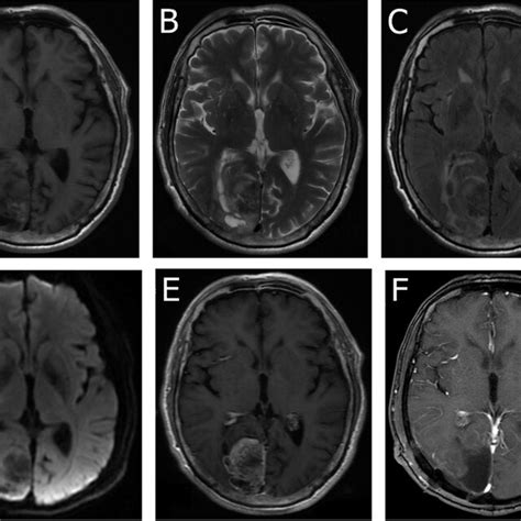 Preoperative MRI showing a mass in the right occipital lobe. A T1w... | Download Scientific Diagram