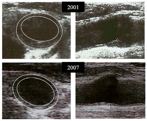 Atherosclerotic Plaque Regression and Arterial Reverse Remodelling in Carotid and Femoral ...