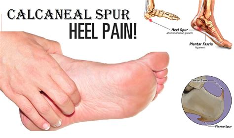 Calcaneal spur Homeopathic Treatment Heel pain Progressive damage