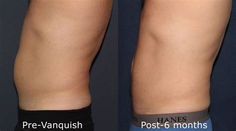 Vanquish San Diego, CA | Cosmetic Laser Dermatology