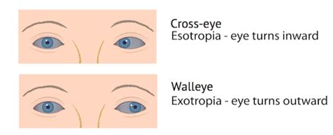 Dissociated vertical and horizontal deviation of vertical strabismus ...