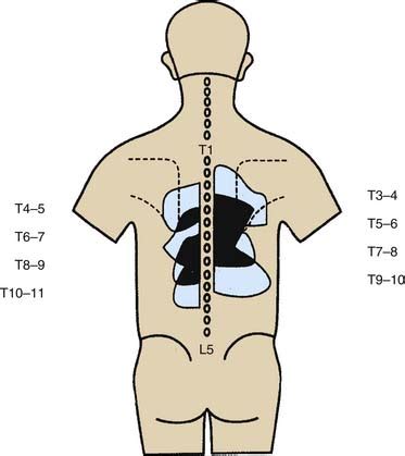 Zygapophysial Joint Pain: Procedures for Diagnosis and Treatment | Clinical Gate