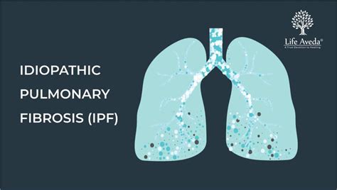 Idiopathic Pulmonary Fibrosis