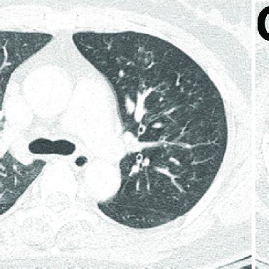 Imaging of 55-year-old immunocompetent woman with human metapneumovirus ...