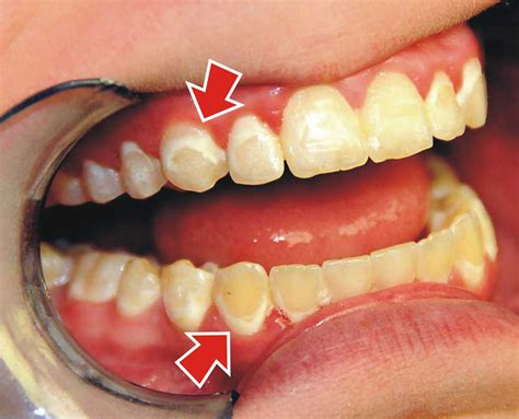 How Do You Treat White Spots After Braces? | Ask an Orthodontist.com