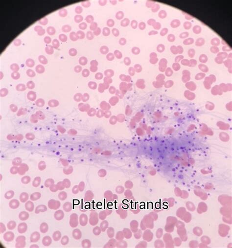 fibrin strands with platelets in a smear | Medical Laboratories