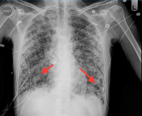 Pneumocystis pneumonia| Interactive Health