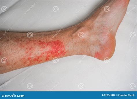 Eczema Skin Disease on the Legs, Itchy Red Rashes and Spots Stock Photo - Image of patient, hand ...