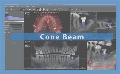 CONE BEAM : El estándar de oro de la imagen seccional 3D