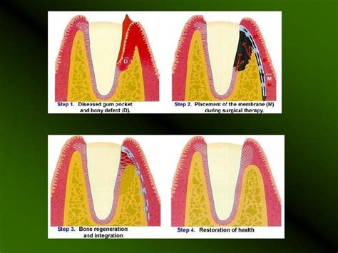 Guided Tissue regeneration and Guided Bone Regeneration Guided