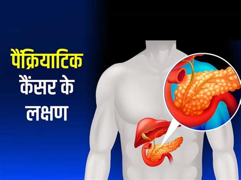 Pancreatic Cancer Symptoms In Hindi | पैंक्रियाटिक कैंसर के लक्षण | TheHealthSite.com हिंदी