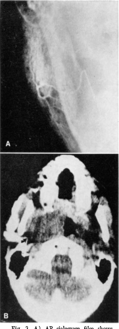 Figure 3 from The Combined Computerized Tomography-Sialogram | Semantic ...