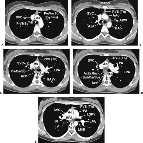 Normal Mediastinum: Regional Anatomy : 네이버 블로그