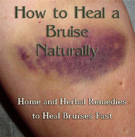 How to Heal a Bruise Naturally | Summer, Cases and Dr. who