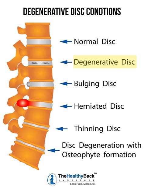 Degenerative Disc Disease: Causes, Symptoms and Treatments