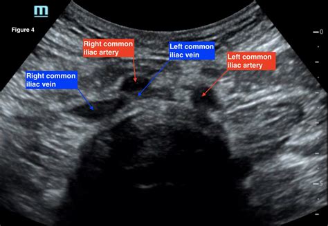 A Case Report of May-Thurner Syndrome Identified on Abdominal ...