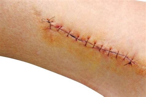 Got Stitches? Here're 8 Ways to Heal Them Faster | Just-Health.net